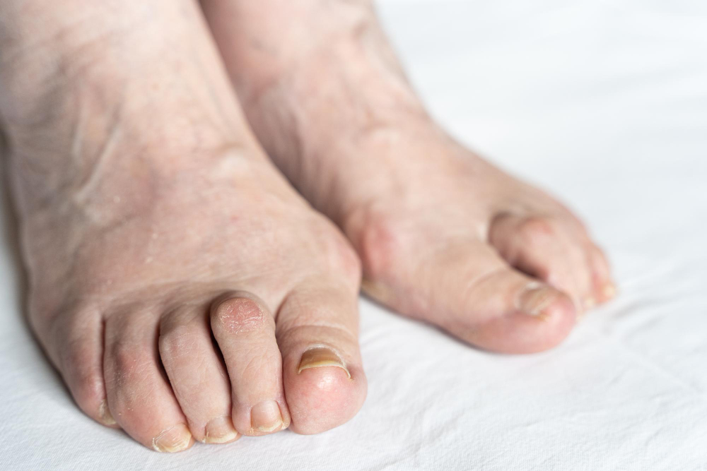 Are Bunions Affecting Your Everyday Life? Orange County Foot & Ankle